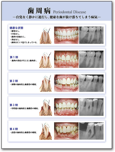 ポスターアート　歯周病 by SmartPractice