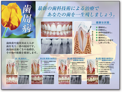 ポスターアート　歯周病 by SmartPractice