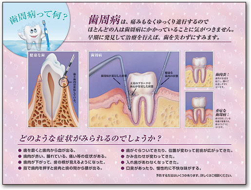 ポスターアート　歯周病って何？ by SmartPractice