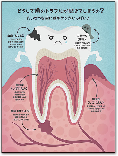 ポスターアート　歯のキケンを学ぼう by SmartPractice